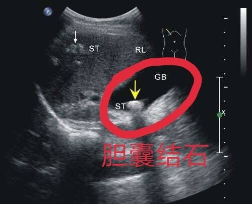 B超能检查出什么